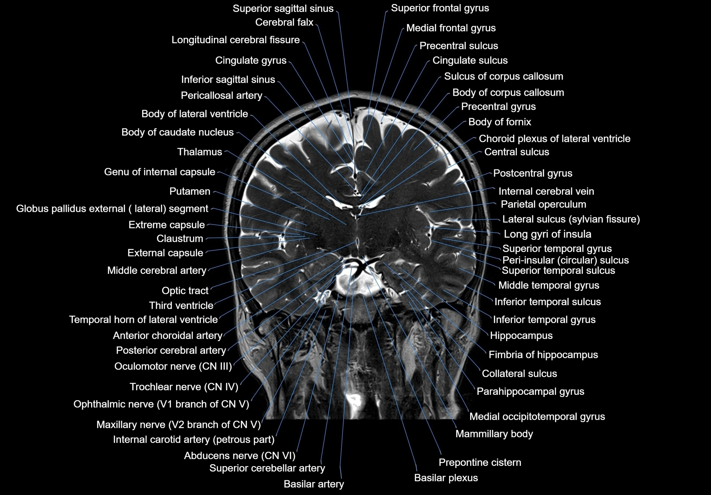 MRI Brain coronal cross sectional labelled anatomy 3T image  -img-00001-00037.webp